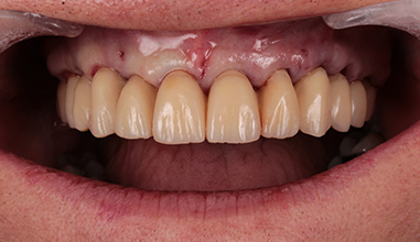 After - Natural Smiles Implant & Cosmetic Dentistry