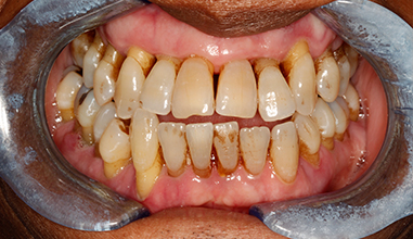 Before - Natural Smiles Implant & Cosmetic Dentistry