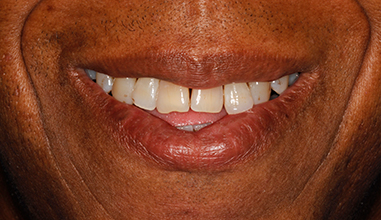 Before - Natural Smiles Implant & Cosmetic Dentistry