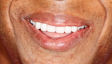 After - Natural Smiles Implant & Cosmetic Dentistry