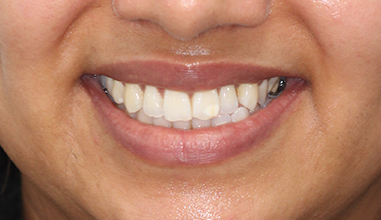 Before - Natural Smiles Implant & Cosmetic Dentistry