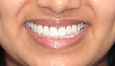 After - Natural Smiles Implant & Cosmetic Dentistry