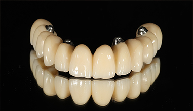 Before - Natural Smiles Implant & Cosmetic Dentistry