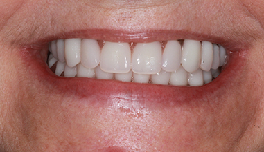 After - Natural Smiles Implant & Cosmetic Dentistry
