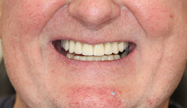 After - Natural Smiles Implant & Cosmetic Dentistry