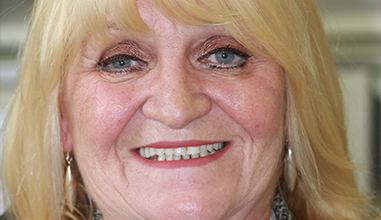 Before - Natural Smiles Implant & Cosmetic Dentistry