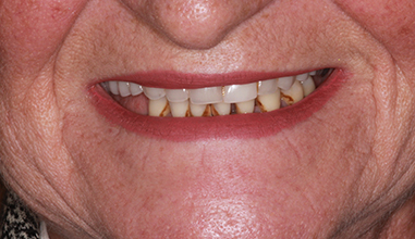 Before - Natural Smiles Implant & Cosmetic Dentistry
