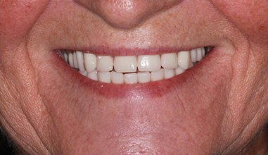 After - Natural Smiles Implant & Cosmetic Dentistry