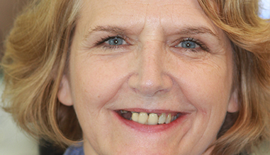 Before - Natural Smiles Implant & Cosmetic Dentistry