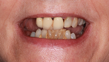 Before - Natural Smiles Implant & Cosmetic Dentistry