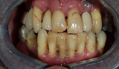 Before - Natural Smiles Implant & Cosmetic Dentistry