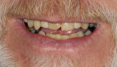 Before - Natural Smiles Implant & Cosmetic Dentistry