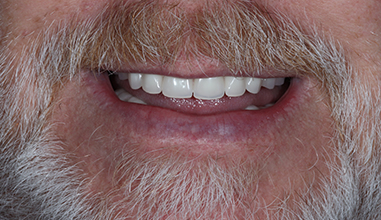 After - Natural Smiles Implant & Cosmetic Dentistry