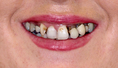 Before - Natural Smiles Implant & Cosmetic Dentistry