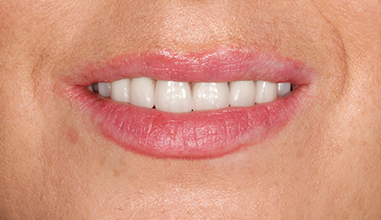 After - Natural Smiles Implant & Cosmetic Dentistry