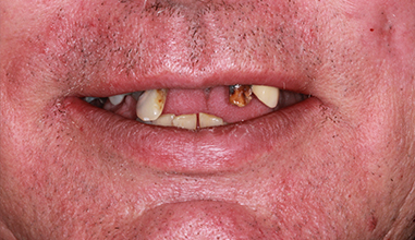 Before - Natural Smiles Implant & Cosmetic Dentistry