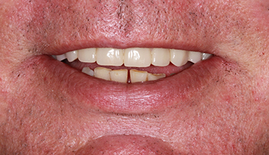 After - Natural Smiles Implant & Cosmetic Dentistry