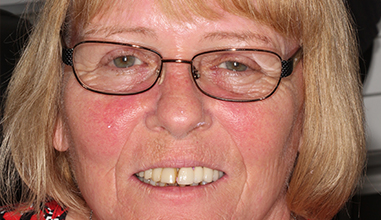 Before - Natural Smiles Implant & Cosmetic Dentistry