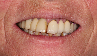 Before - Natural Smiles Implant & Cosmetic Dentistry