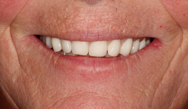 After - Natural Smiles Implant & Cosmetic Dentistry