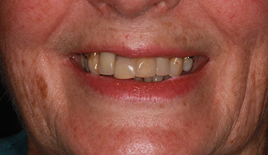 Before - Natural Smiles Implant & Cosmetic Dentistry