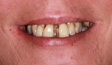 Before - Natural Smiles Implant & Cosmetic Dentistry