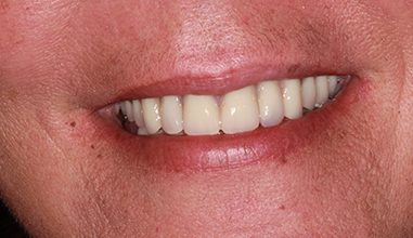 After - Natural Smiles Implant & Cosmetic Dentistry