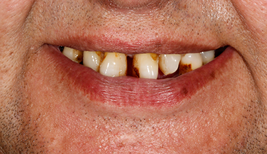 Before - Natural Smiles Implant & Cosmetic Dentistry