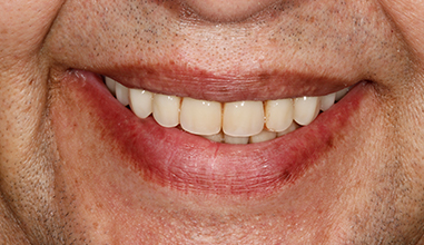 After - Natural Smiles Implant & Cosmetic Dentistry