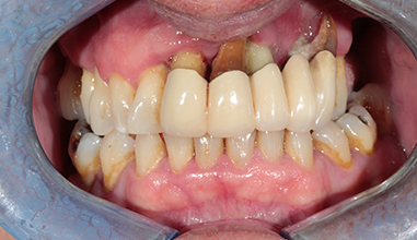 Before - Natural Smiles Implant & Cosmetic Dentistry