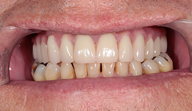 After - Natural Smiles Implant & Cosmetic Dentistry