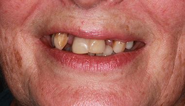 Before - Natural Smiles Implant & Cosmetic Dentistry