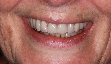 After - Natural Smiles Implant & Cosmetic Dentistry