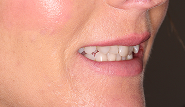 Before - Natural Smiles Implant & Cosmetic Dentistry