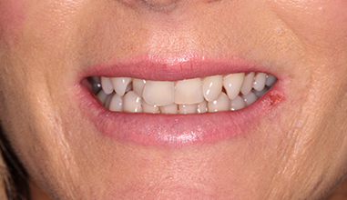 Before - Natural Smiles Implant & Cosmetic Dentistry
