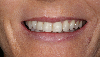 After - Natural Smiles Implant & Cosmetic Dentistry