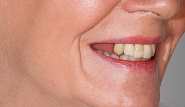 Before - Natural Smiles Implant & Cosmetic Dentistry