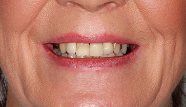 Before - Natural Smiles Implant & Cosmetic Dentistry