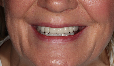After - Natural Smiles Implant & Cosmetic Dentistry