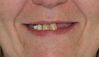 Before - Natural Smiles Implant & Cosmetic Dentistry