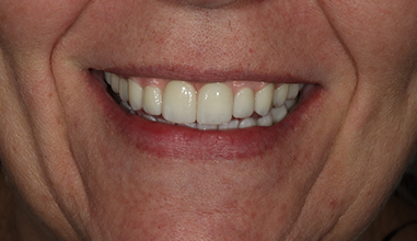 After - Natural Smiles Implant & Cosmetic Dentistry