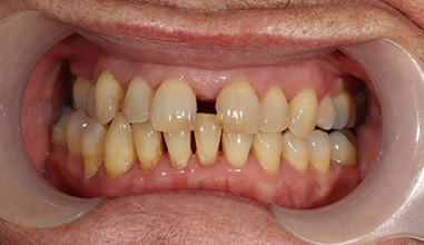 Before - Natural Smiles Implant & Cosmetic Dentistry