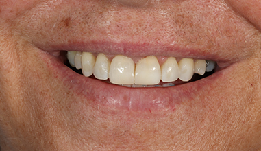 After - Natural Smiles Implant & Cosmetic Dentistry