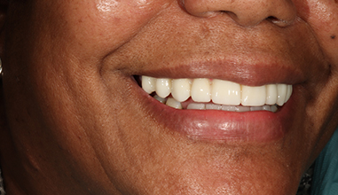 Before - Natural Smiles Implant & Cosmetic Dentistry