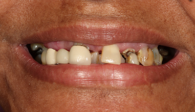Before - Natural Smiles Implant & Cosmetic Dentistry