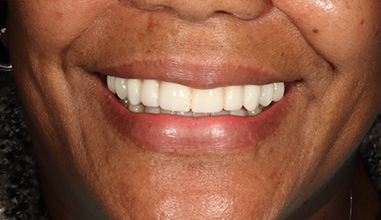 After - Natural Smiles Implant & Cosmetic Dentistry