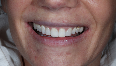 Before - Natural Smiles Implant & Cosmetic Dentistry