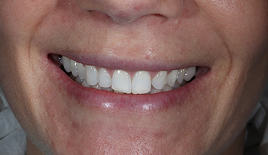 After - Natural Smiles Implant & Cosmetic Dentistry