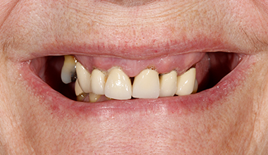 Before - Natural Smiles Implant & Cosmetic Dentistry