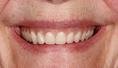 After - Natural Smiles Implant & Cosmetic Dentistry